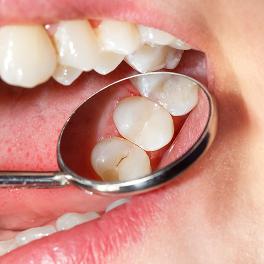 Dental mirror being used to examine tooth with filling