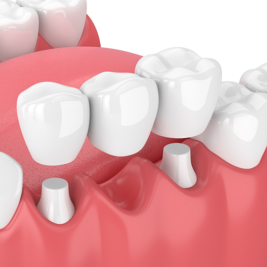 Illustration of dental bridge being placed on repaired teeth