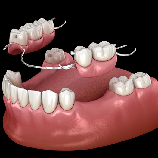 Illustration of partial dentures in Fort Smith