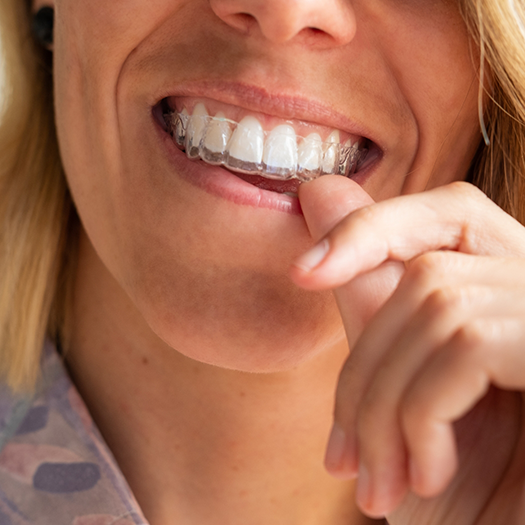 Close up of smiling woman wearing a clear aligner