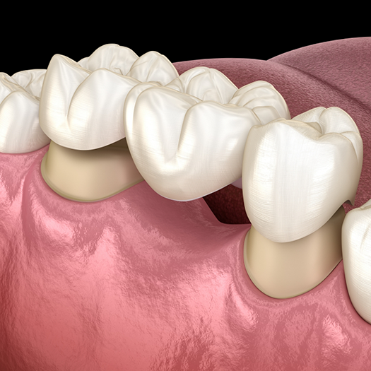 Illustration of a dental bridge for replacing lower teeth