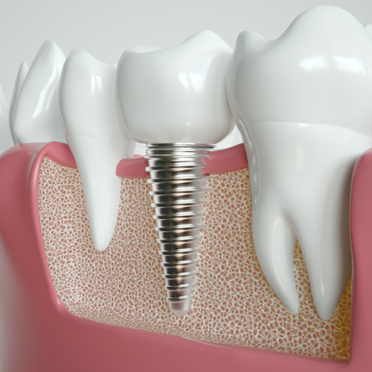 Illustration of dental implant inserted between natural teeth