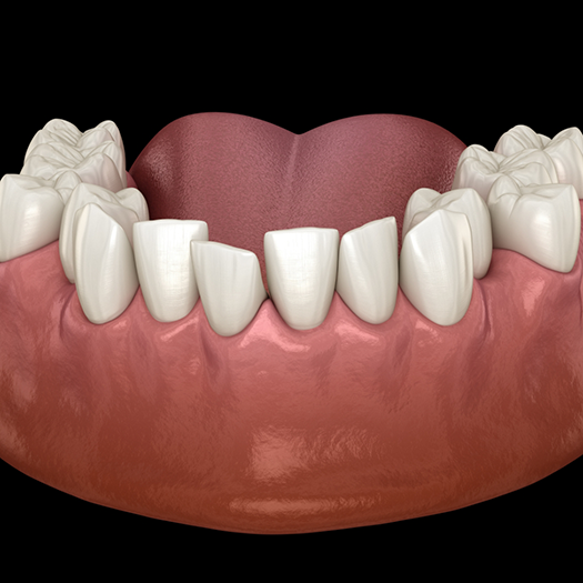 Illustration of crooked teeth in lower arch