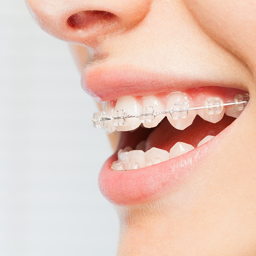 Close-up of smile with braces with clear brackets