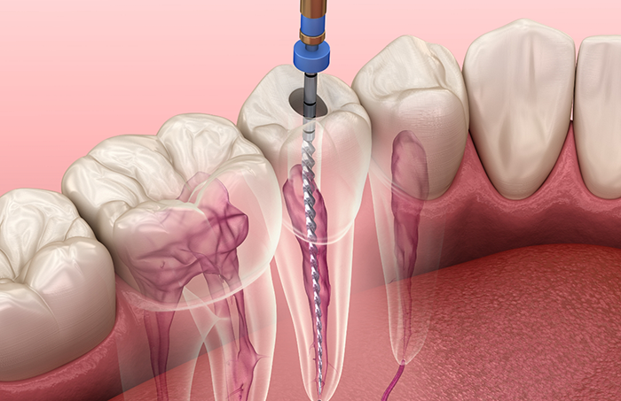 Illustration of root canal treatment in Fort Smith