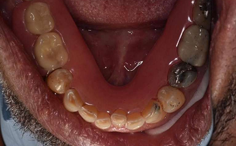 Mouth before treatment