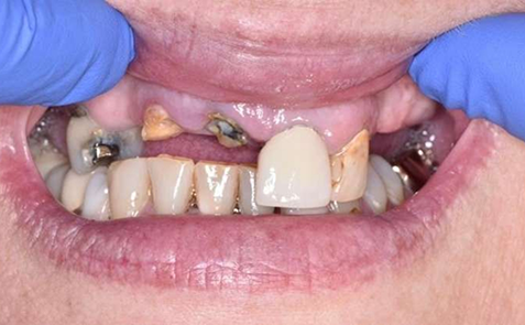 Mouth with most teeth missing in upper arch