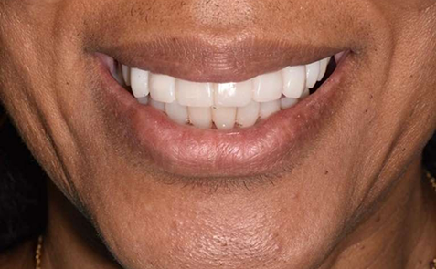 Smile with brightened teeth