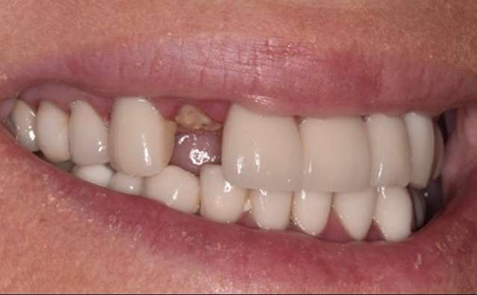 Close up of gap left by missing tooth