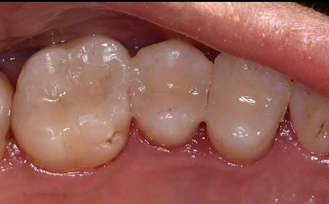 Close up of tooth after decay has been treated