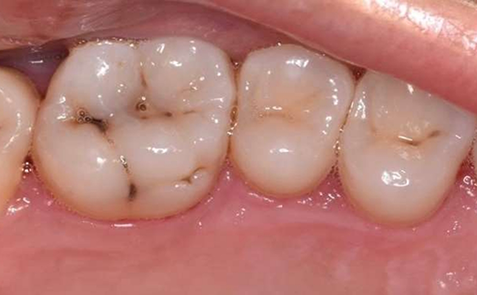 Close up of decayed tooth