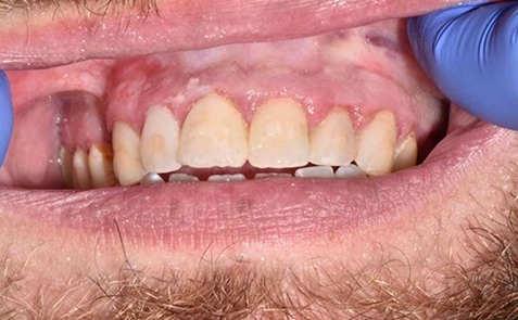 Close up of teeth after damaged has been repaired