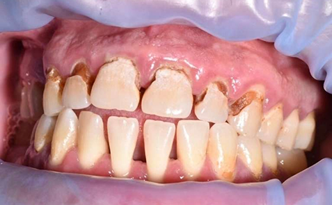 Close up of teeth damaged near roots