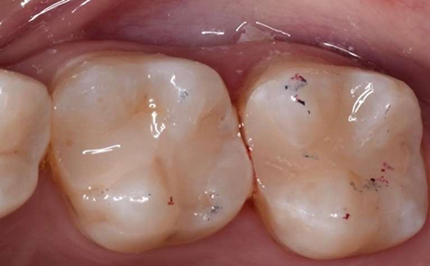 Close up of teeth post treatment