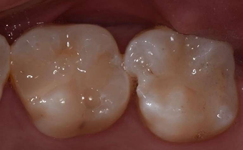 Close up of teeth prior to treatment