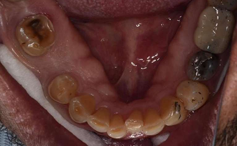 Mouth after treatment