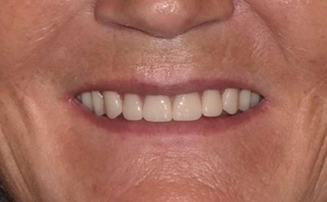 Woman smiling with teeth that have been built back up