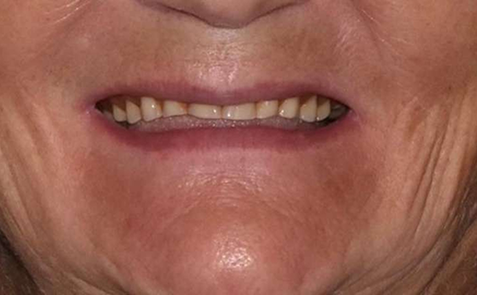 Woman smiling with worn down teeth