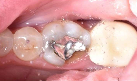 Tooth with metal restoration