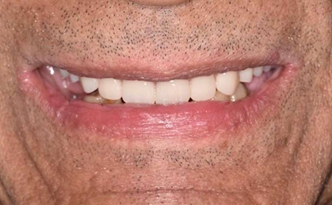 Mouth with repaired and replaced teeth