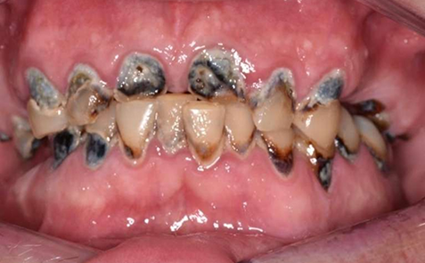 Mouth with multiple decayed teeth