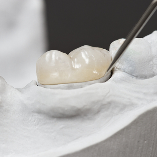 Close up of a dental crown on model of teeth