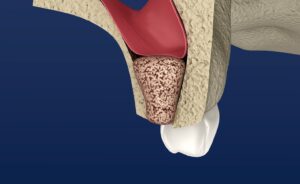 Sinus lift and bone grafting procedure